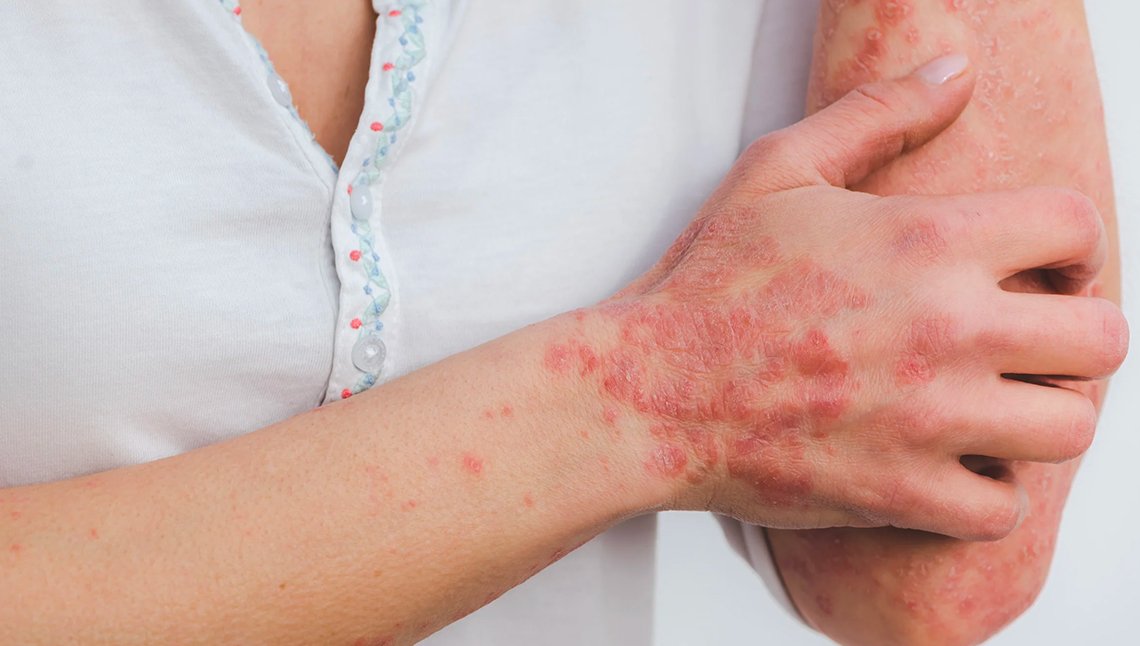 Psoriasi, cos'è e come trattarla Psoriasi, cos'è e come trattarla