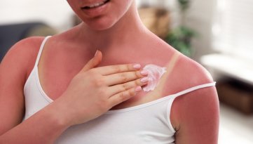 Cosa succede alla pelle se prendiamo il sole senza protezione?