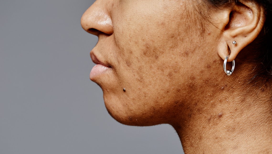 L'acne ormonale negli adulti: cause, sintomi e trattamenti